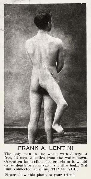 THREE-LEGGED MAN, c1915. Pitch card featuring Francesco A. Lentini, a Sicilian-born three-legged man who toured with circuses, c1915