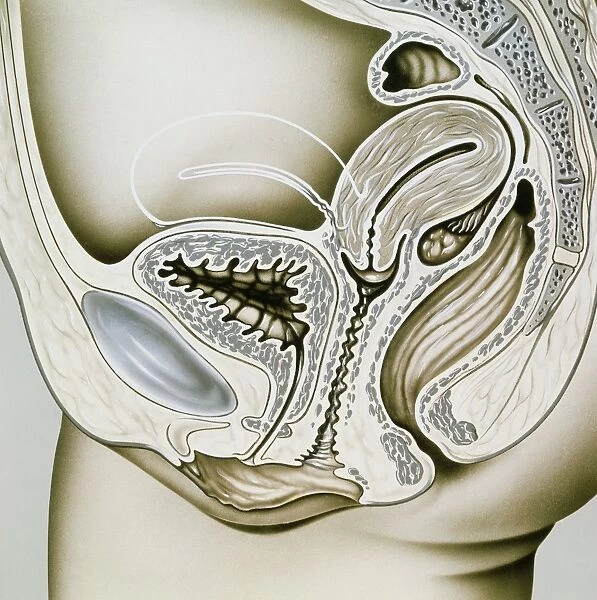 Artwork of retroflexion of the uterus
