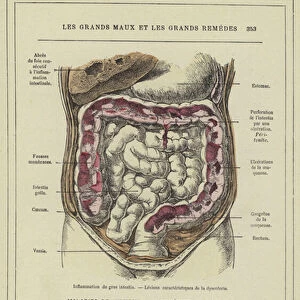 Inflammation du gros intestin, Lesions caracteristiques de la dysenterie (colour litho)